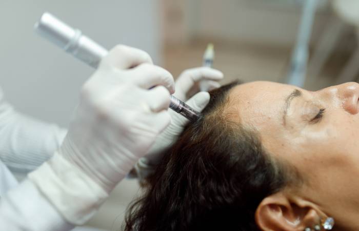 Microneedling with PRP for Acne and Scalp