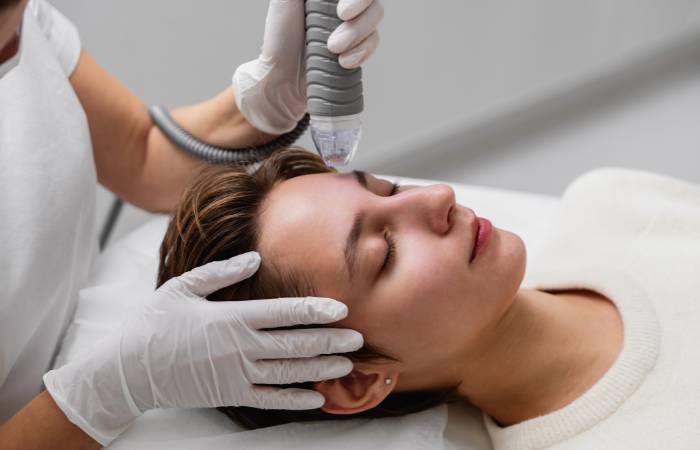 Microneedling with PRP for Acne and Scalp