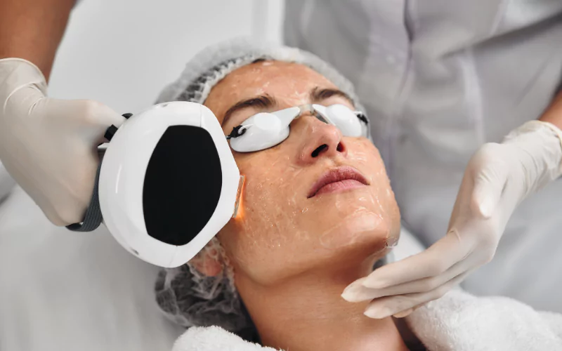 Woman undergoing Lumecca IPL treatment, with protective eyewear and gel applied to her face, highlighting skin rejuvenation process.