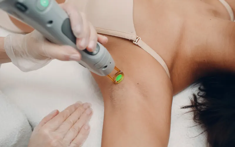 laser hair removal in Bradenton