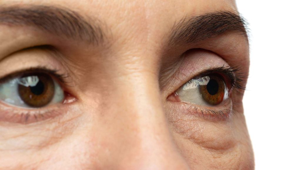 The Power of PRP Under Eye Treatment for Dark Circles