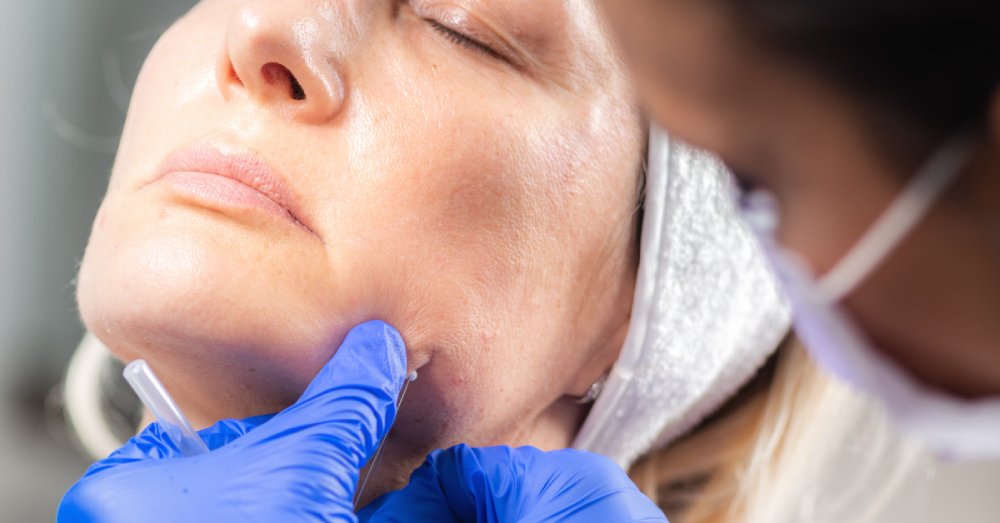 How Long Do PDO Threads Last for Jawline Contouring?