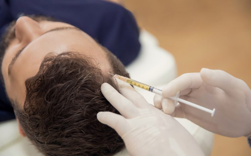 Patient receiving PRP hair treatment injection on the scalp, highlighting the procedure's application for hair restoration.