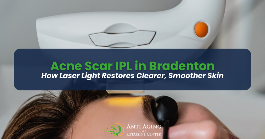 Acne Scar IPL in Bradenton How Laser Light Restores Clearer, Smoother Skin